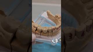 ZIRCONIA BRIDGE WITH MESIALLY TILTED MOLAR 假牙 全口重建 全瓷冠 牙橋 [upl. by Adnilev245]