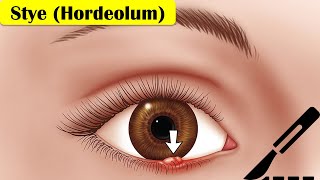 Stye Hordeolum  Causes Pathogenesis Signs amp Symptoms And Treatment [upl. by Joyan]