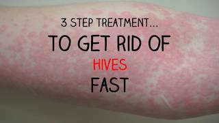 INCREDIBLE 3 Step Treatment To Get Rid Of Your Hives FAST [upl. by Ijuy9]