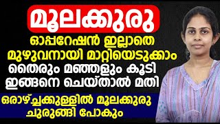 മൂലക്കുരു ഓപ്പറേഷൻ ഇല്ലാതെ മുഴുവനായി മാറ്റിയെടുക്കാം [upl. by Axela452]