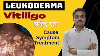 leucoderma vitiligo treatment by homeopathic medicine explain [upl. by Ross]