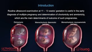 UOG video abstract Outcome of twin pregnancy with two live fetuses at 11–13 weeks’ gestation [upl. by Euhsoj520]