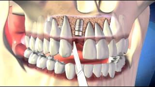 Dental implant  3D Medical Animation  ABP © [upl. by Cirilla]