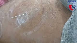 KNCH Hospital  Relieve Pain amp Boost Healing with Dry Needling and Cupping [upl. by Arytahs]