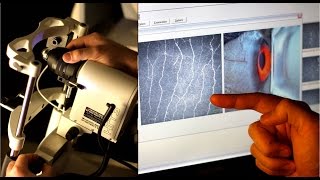 Corneal confocal microscopy image acquisition part 1 [upl. by Ehcram250]