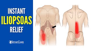 How to Instantly Relieve Iliopsoas Muscle Tightness AND PAIN [upl. by Bernetta]