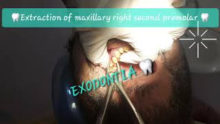 Buccal to lingual motion maxillary 2nd premolar extraction with double curvatures Sshaped roots [upl. by Nahem839]