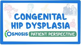 Patient Perspective Congenital hip dysplasia [upl. by Gabel508]