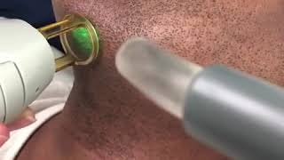 Laser Hair Removal for treatment of Pseudofilliculitis Barbae razor bumps [upl. by Odlopoel82]