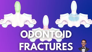 Odontoid Fracture Presentation Mechanism Classification and Management [upl. by Velma]