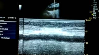 IVC m mode in an overloaded patient [upl. by Limay]