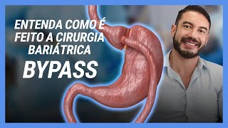 Entenda como é feito a Cirurgia Bariátrica BYPASS  Dr Leonardo Fiuza [upl. by Larkins]