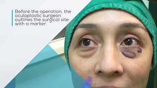 Lower eyelid blepharoplasty surgery to remove bags under the eyes [upl. by Allit]