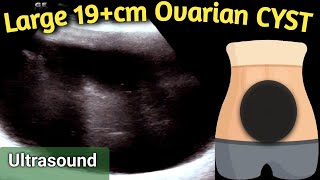 Ultrasound 19 cm Large Ovarian Cyst  equal to size of Handball in Abdomen [upl. by Trella247]