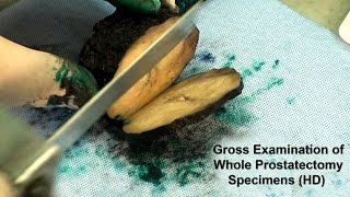 Pathology Gross Examination of Whole Prostatectomy Specimens [upl. by Alenas]