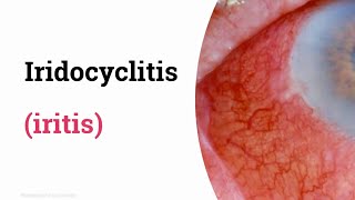 Iridocyclitis iritis [upl. by Ary]