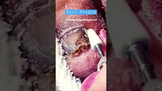 Do you want to know the best product for Nail Fungus nailenthusiast pedicure nailfungus [upl. by Ainalem]