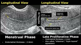 Endometrial Thickness Ultrasound Image Appearances  Endometrium Menstrual Cycle USG Images [upl. by Radford]