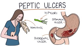 Understanding Stomach and Duodenal Ulcers [upl. by Aniat]