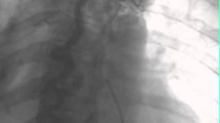 Coarctation of Aorta and Aortic Aneurysm and severe Aortic insufficiency [upl. by Adigun]