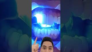 Carillas dentales de resina es tu mejor opción dientes dentista tips parati viral fyp [upl. by Giacinta683]