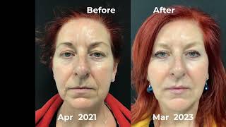 Nonsurgical Facelift combination of Dermal Fillers Ellanse HydraFacial and Sofwave [upl. by Aridni]