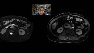 Paraganglioma [upl. by Halil]