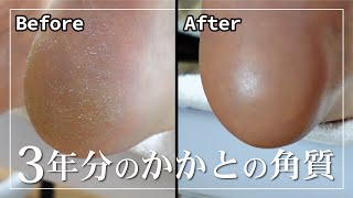 【一生取れる角質】フットケアでつるつるになりました！後編角質除去フットマッサージネイルケア [upl. by Ronnie354]