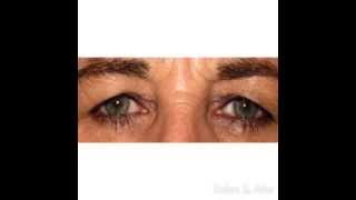 Ptosis Repair with a Levator Advancement in Tampa FL [upl. by Vlad]