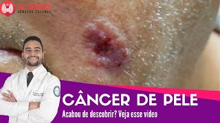 Câncer de pele  Vídeo para quem acabou de descobrir  Dr Jônatas Catunda [upl. by Dnalyar]