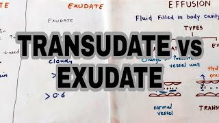 Transudate vs Exudate  Types of effusion  lights criteria [upl. by Zzabahs410]