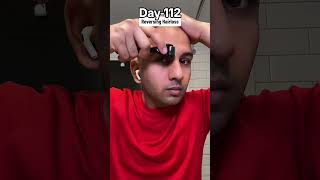 Day112 of Restoring Hairline [upl. by Libb593]