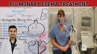 Pulmonary edema diagnosis treatment in Hindi  pulmonary edema treatment [upl. by Mckay571]