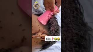 🤮Lice Removal Home Remedies Lice Removal Tips 💯 shorts haircare liceremoval [upl. by Ahsenet277]