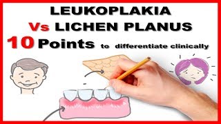 leukoplakia vs lichen planus  10 points to differentiate clinically [upl. by Arit]