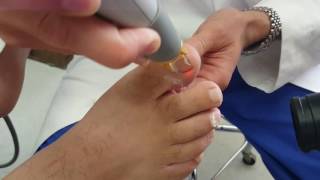 Laser Treatment of Fungal Toe Nail with a Cutera Laser [upl. by Ring]