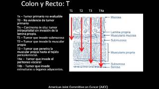 Clase Web TNM y clasificación por estadíos de cáncer de colon y recto  Versión 7 del AJCC [upl. by Davidoff]