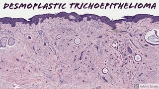 Desmoplastic Trichoepithelioma 5Minute Pathology Pearls [upl. by Mirielle]