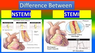 Contrast between NSTEMI and STEMI [upl. by Wrigley]