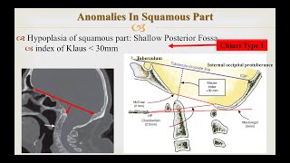 Craniovertebral Junction Anomalies Part 1 Occipital Anomalies Chiari Malformations [upl. by Fine]