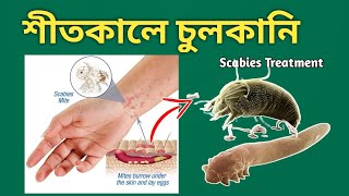 Scabies চুলকানির চিকিৎসা [upl. by Erme]