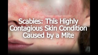 Scabies This Highly Contagious Skin Condition Caused by a Mite [upl. by Siul337]