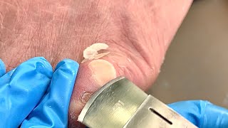 Callus removal from feetampFoot scraping dead skin【Xiao Yan pedicure】stress 76 [upl. by Gnoix]