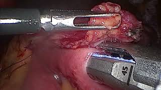 Revisional Single Anastomosis Sleeve Ileal Bypass [upl. by Bryant]