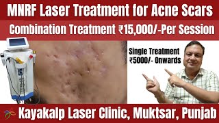 MNRF Laser Treatment for Acne Scar  Cost and Sessions  Acne Scar [upl. by Peednama609]