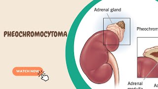 Pheochromocytoma [upl. by Guglielma]