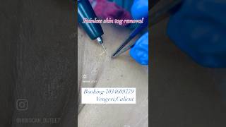 SKIN TAG REMOVAL hibiscan painlessskintagremoval kozhikode viralvideo allkerala [upl. by Cranston]