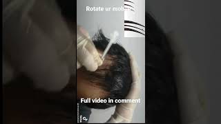 Microneedling hair growth procedure minor surgery [upl. by Lazare]