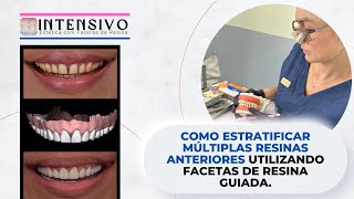 Como estratificar múltiplas resinas anteriores utilizando facetas de resina guiada [upl. by Anagrom749]