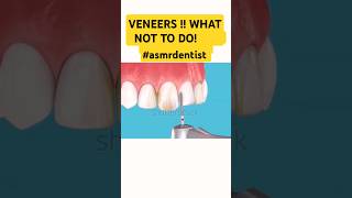 Veneers WHAT NOT TO DO shorts dentist smileasmrdentist [upl. by Anaeel]